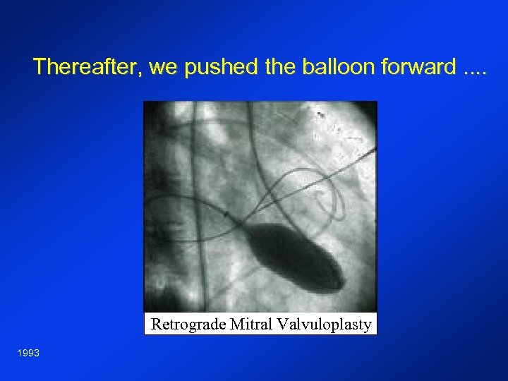 Thereafter, we pushed the balloon forward. . Retrograde Mitral Valvuloplasty 1993 