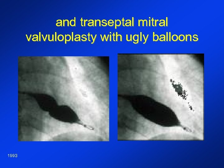 and transeptal mitral valvuloplasty with ugly balloons 1993 