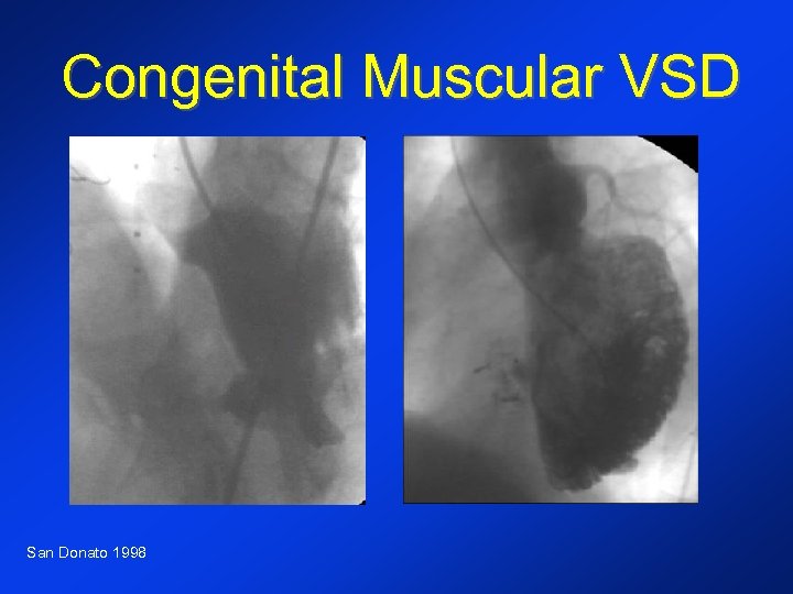 Congenital Muscular VSD San Donato 1998 