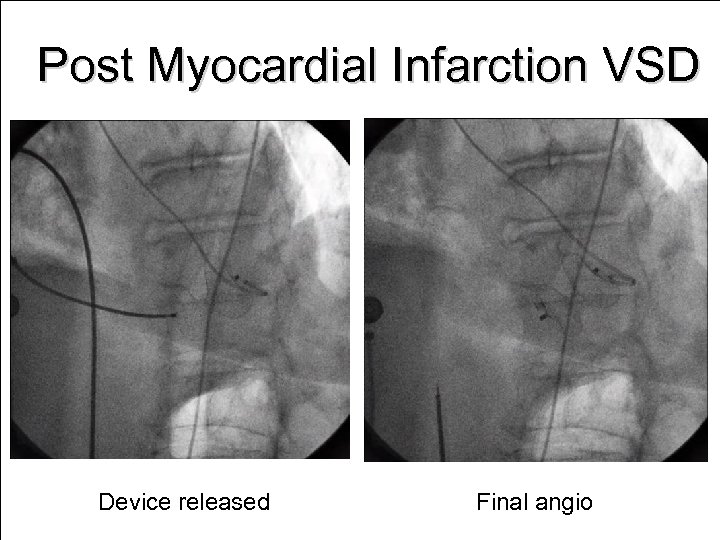 Post Myocardial Infarction VSD Device released Final angio 