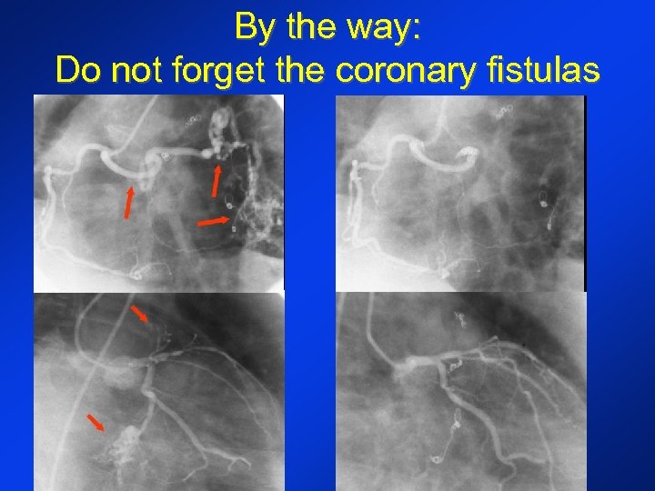 By the way: Do not forget the coronary fistulas 