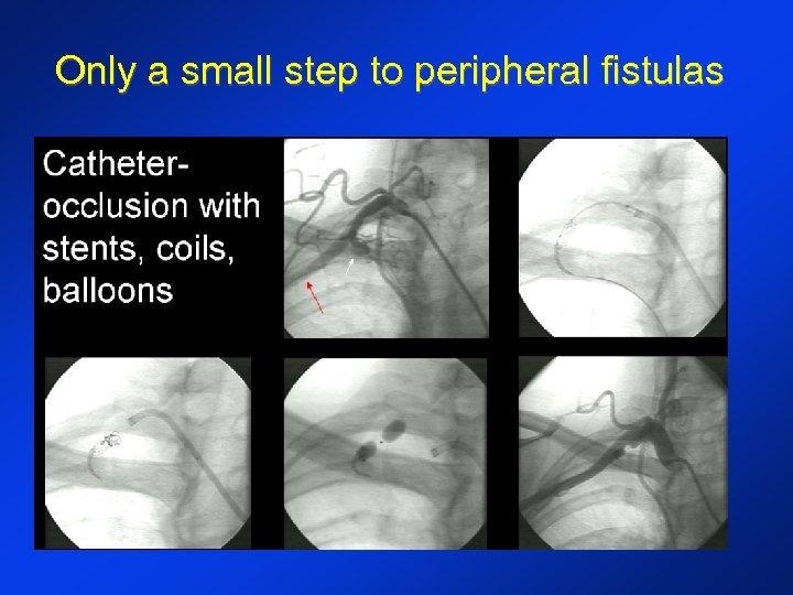 Only a small step to peripheral fistulas 