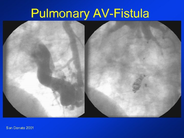 Pulmonary AV-Fistula San Donato 2001 