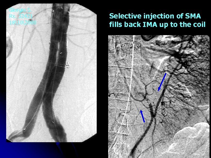 Giorgio S. Rx. 32421 18102000 Selective injection of SMA fills back IMA up to