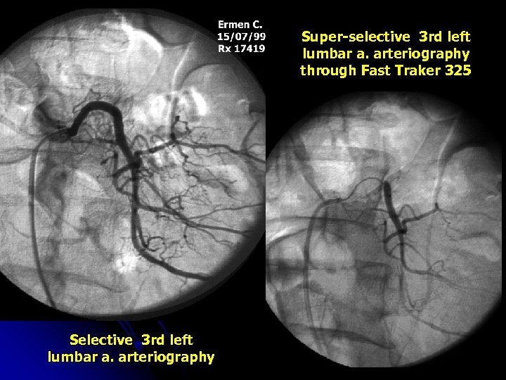 Super-selective 3 rd left lumbar a. arteriography through Fast Traker 325 Selective 3 rd