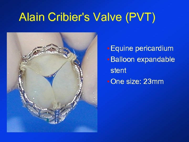 Alain Cribier's Valve (PVT) • Equine pericardium • Balloon expandable stent • One size: