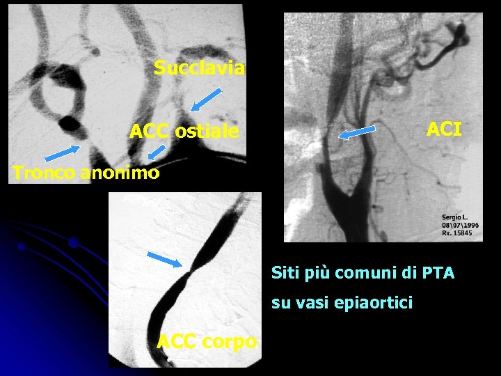 Succlavia ACI ACC ostiale Tronco anonimo Siti più comuni di PTA su vasi epiaortici