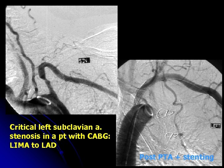 Critical left subclavian a. stenosis in a pt with CABG: LIMA to LAD Post