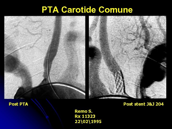 PTA Carotide Comune Post PTA Post stent J&J 204 Remo S. Rx 11323 22�21995