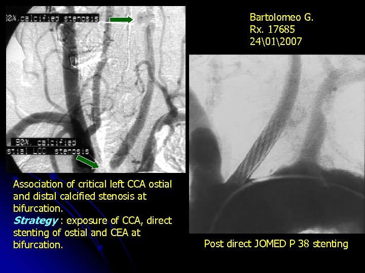 Bartolomeo G. Rx. 17685 24�12007 Association of critical left CCA ostial and distal calcified