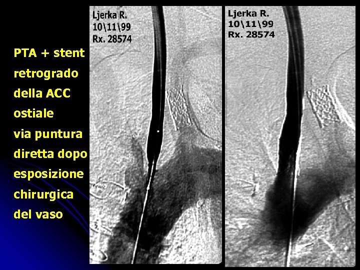 PTA + stent retrogrado della ACC ostiale via puntura diretta dopo esposizione chirurgica del