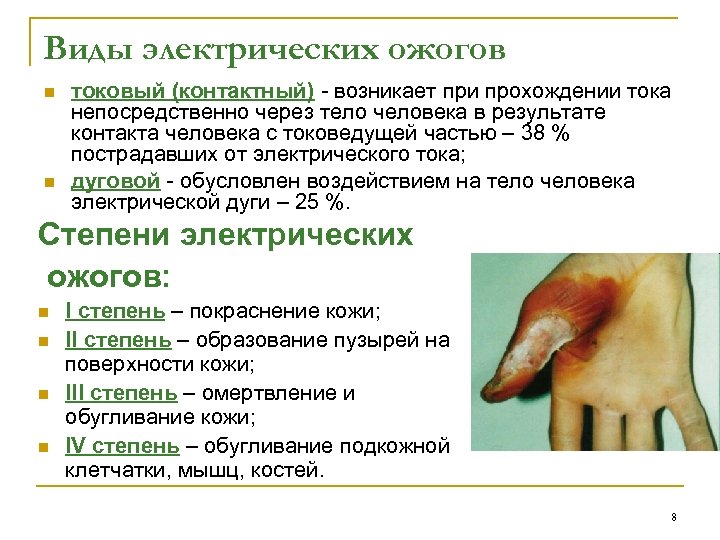 Виды электрических ожогов n n токовый (контактный) - возникает при прохождении тока непосредственно через