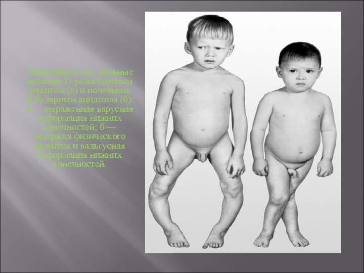  Мальчики 6 лет, больные витамин-D-резистентным рахитом (а) и почечным тубулярным ацидозом (б): а