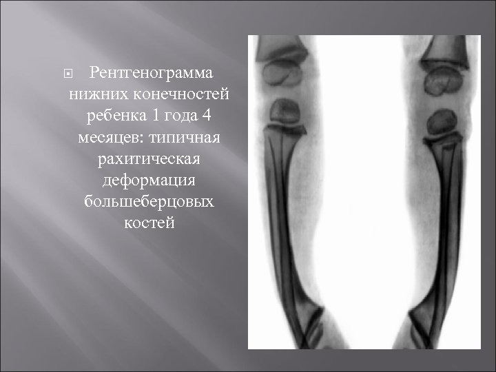  Рентгенограмма нижних конечностей ребенка 1 года 4 месяцев: типичная рахитическая деформация большеберцовых костей