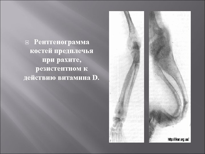 Рентгенограмма костей предплечья при рахите, резистентном к действию витамина D. 