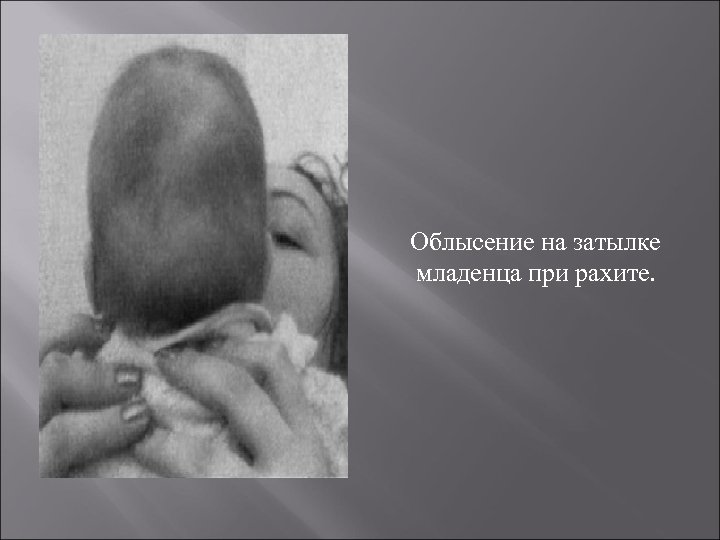  Облысение на затылке младенца при рахите. 