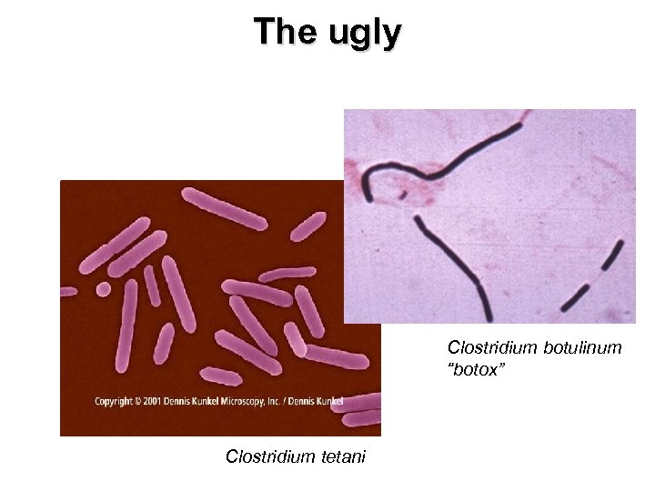 The ugly Clostridium botulinum “botox” Clostridium tetani 