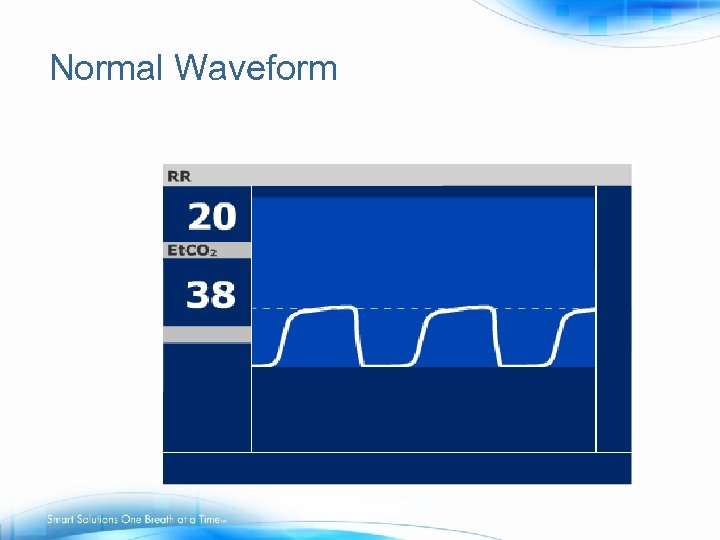 Normal Waveform 