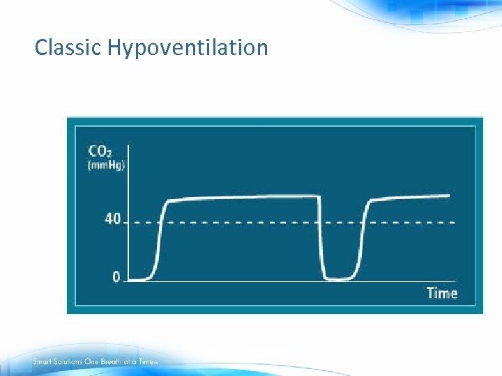 Classic Hypoventilation 