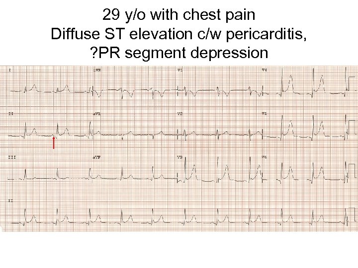 29 y/o with chest pain Diffuse ST elevation c/w pericarditis, ? PR segment depression