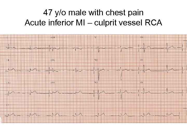 47 y/o male with chest pain Acute inferior MI – culprit vessel RCA 