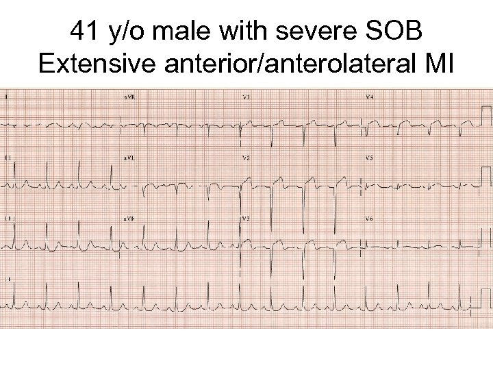 41 y/o male with severe SOB Extensive anterior/anterolateral MI 