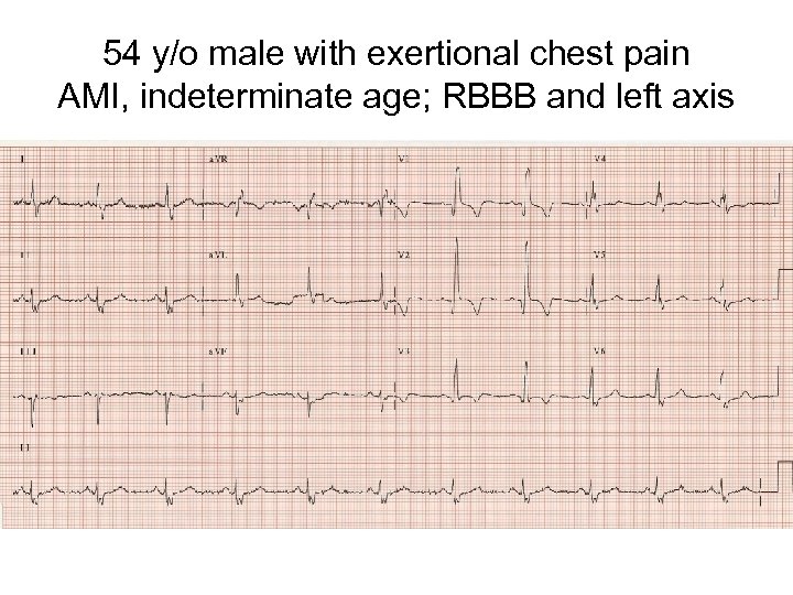 54 y/o male with exertional chest pain AMI, indeterminate age; RBBB and left axis