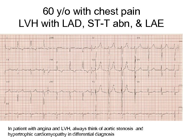 60 y/o with chest pain LVH with LAD, ST-T abn, & LAE In patient