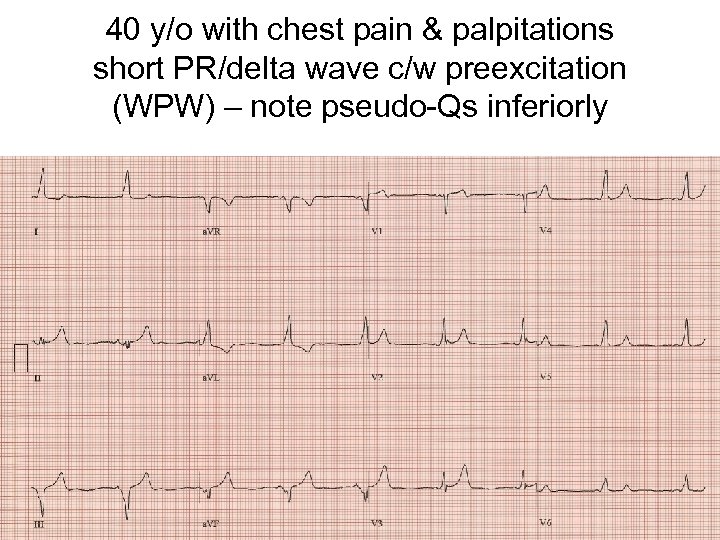 40 y/o with chest pain & palpitations short PR/delta wave c/w preexcitation (WPW) –