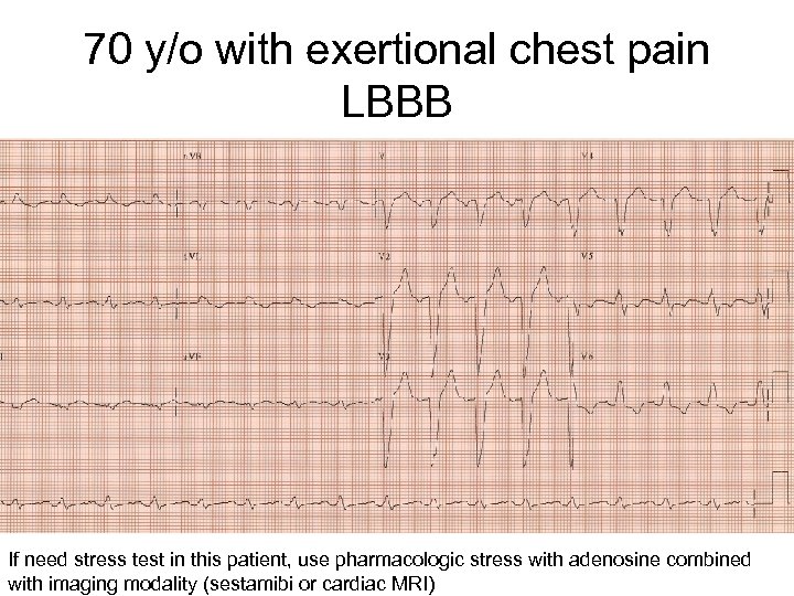 70 y/o with exertional chest pain LBBB If need stress test in this patient,