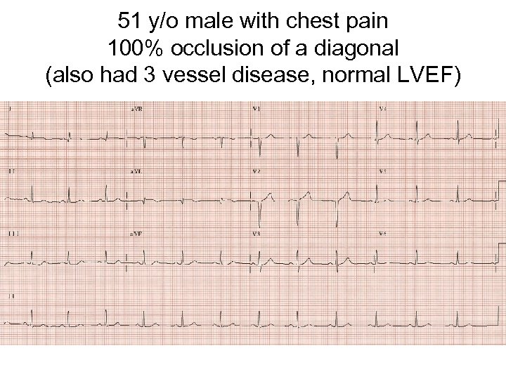 51 y/o male with chest pain 100% occlusion of a diagonal (also had 3