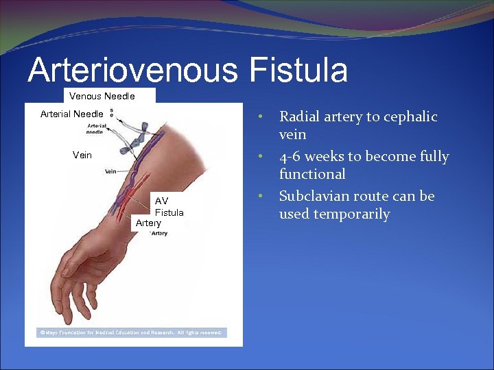 Arteriovenous Fistula Venous Needle • Arterial Needle • Vein AV Fistula Artery • Radial