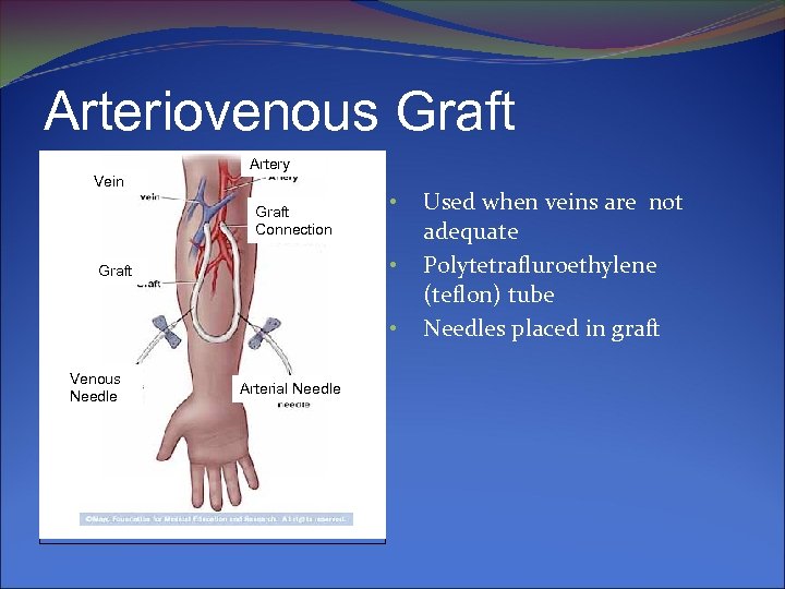 Arteriovenous Graft Artery Vein Graft Connection • • Graft • Venous Needle Arterial Needle