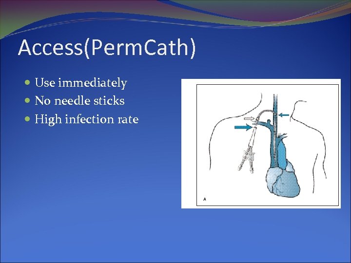 Access(Perm. Cath) Use immediately No needle sticks High infection rate 