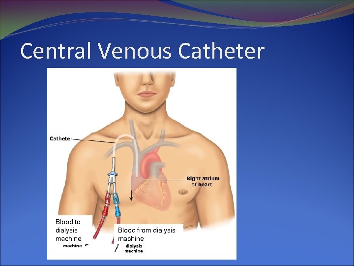 Central Venous Catheter Blood to dialysis machine Blood from dialysis machine 