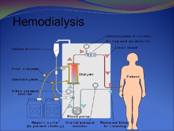 Hemodialysis 