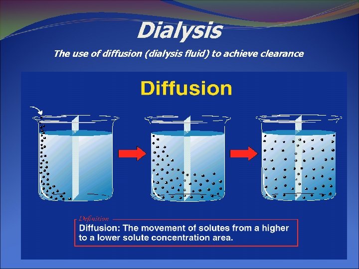 Dialysis The use of diffusion (dialysis fluid) to achieve clearance 