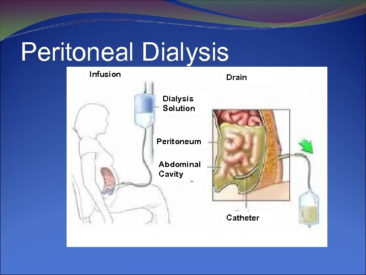 Peritoneal Dialysis Infusion Drain Dialysis Solution Peritoneum Abdominal Cavity Catheter 
