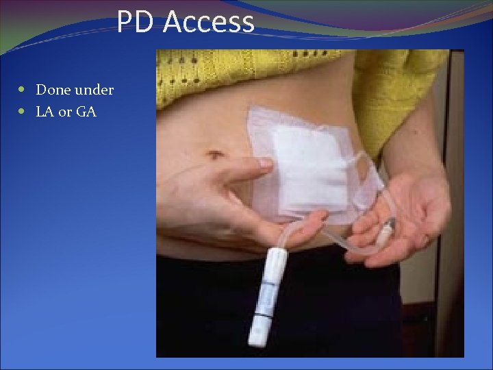 PD Access Done under LA or GA 
