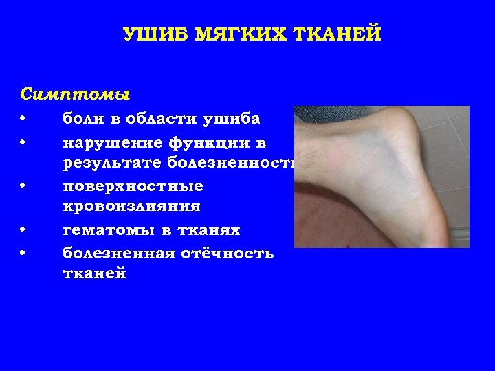 УШИБ МЯГКИХ ТКАНЕЙ Симптомы : • • • боли в области ушиба нарушение функции