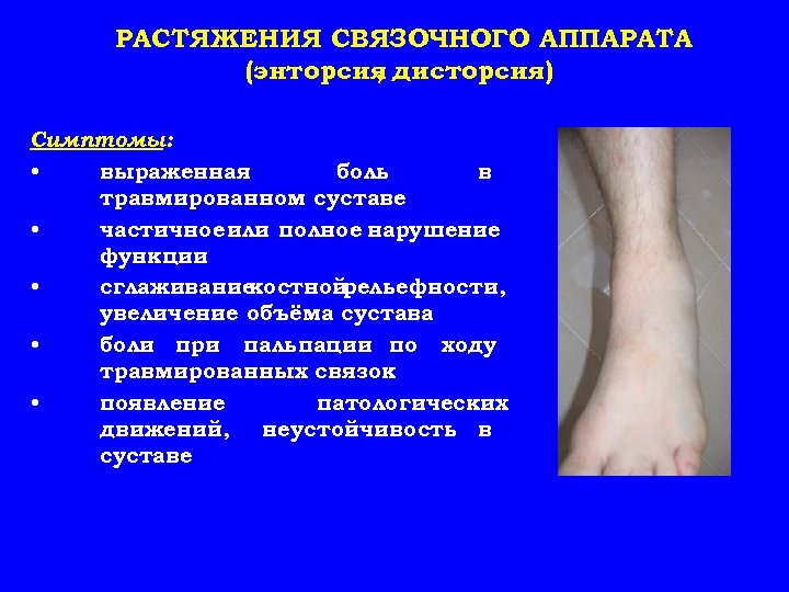 РАСТЯЖЕНИЯ СВЯЗОЧНОГО АППАРАТА (энторсия дисторсия) , Симптомы: • выраженная боль в травмированном суставе •