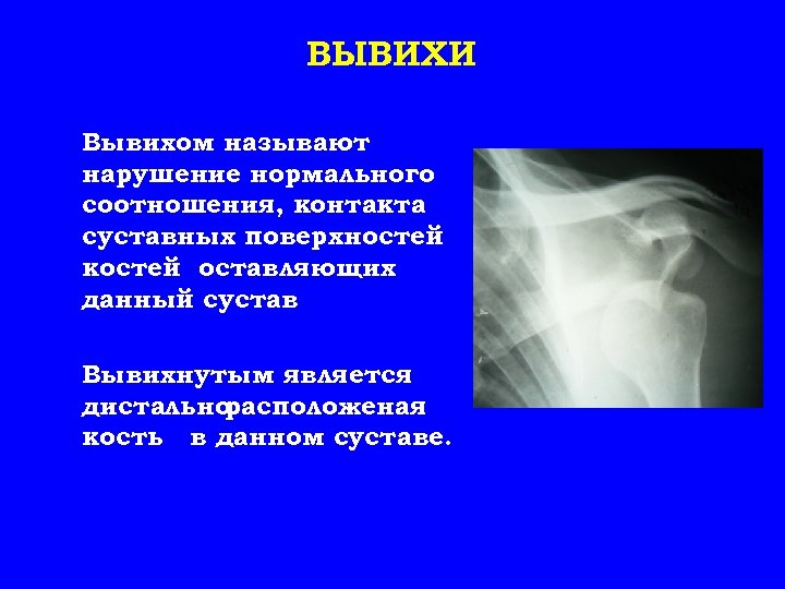 ВЫВИХИ Вывихом называют нарушение нормального соотношения, контакта суставных поверхностей костей оставляющих данный сустав Вывихнутым