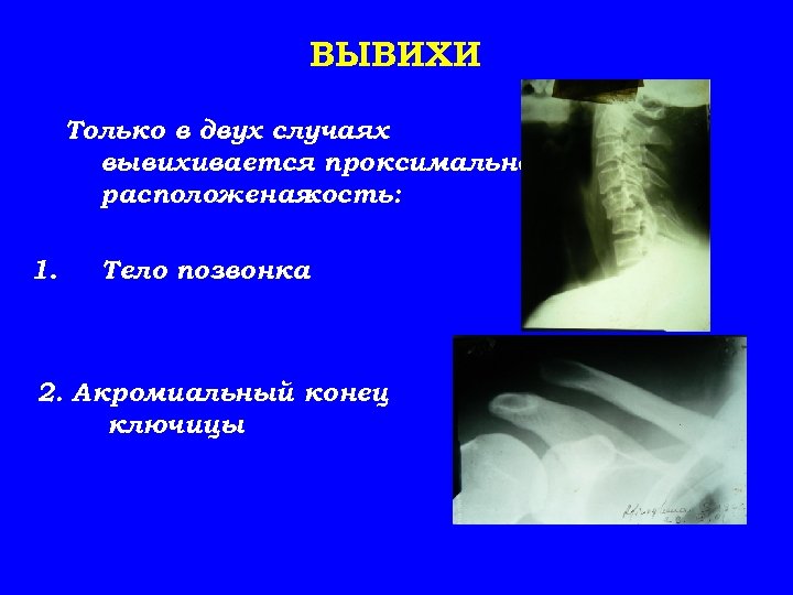 ВЫВИХИ Только в двух случаях вывихивается проксимально расположеная кость: 1. Тело позвонка 2. Акромиальный