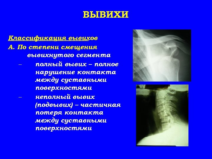 ВЫВИХИ Классификация вывихов А. По степени смещения вывихнутого сегмента – полный вывих – полное