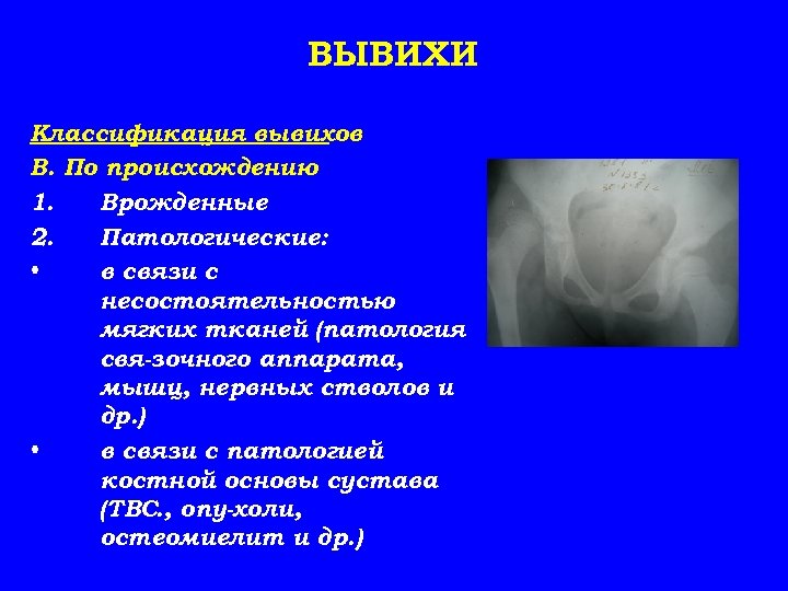 ВЫВИХИ Классификация вывихов В. По происхождению 1. Врожденные 2. Патологические: • в связи с