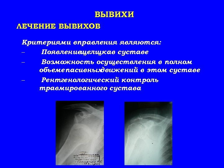 ВЫВИХИ ЛЕЧЕНИЕ ВЫВИХОВ Критериями вправления являются: – Появлениещелщкав суставе – Возможность осуществления в полном