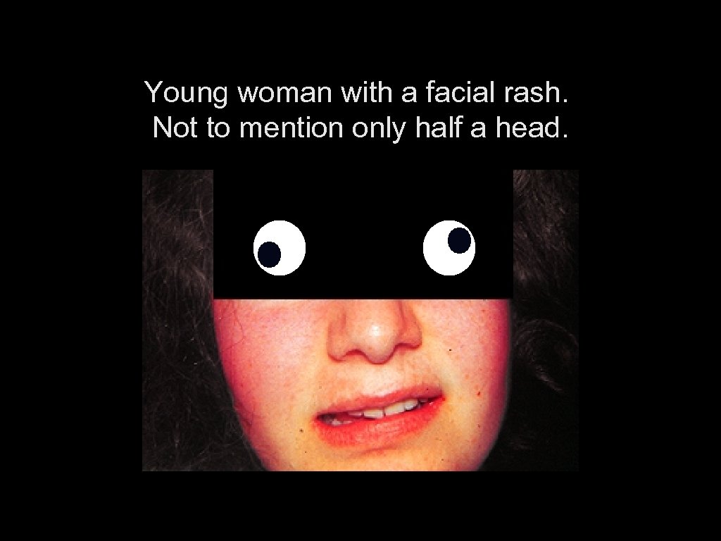 Young woman with a facial rash. Not to mention only half a head. 