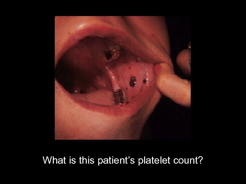 What is this patient’s platelet count? 