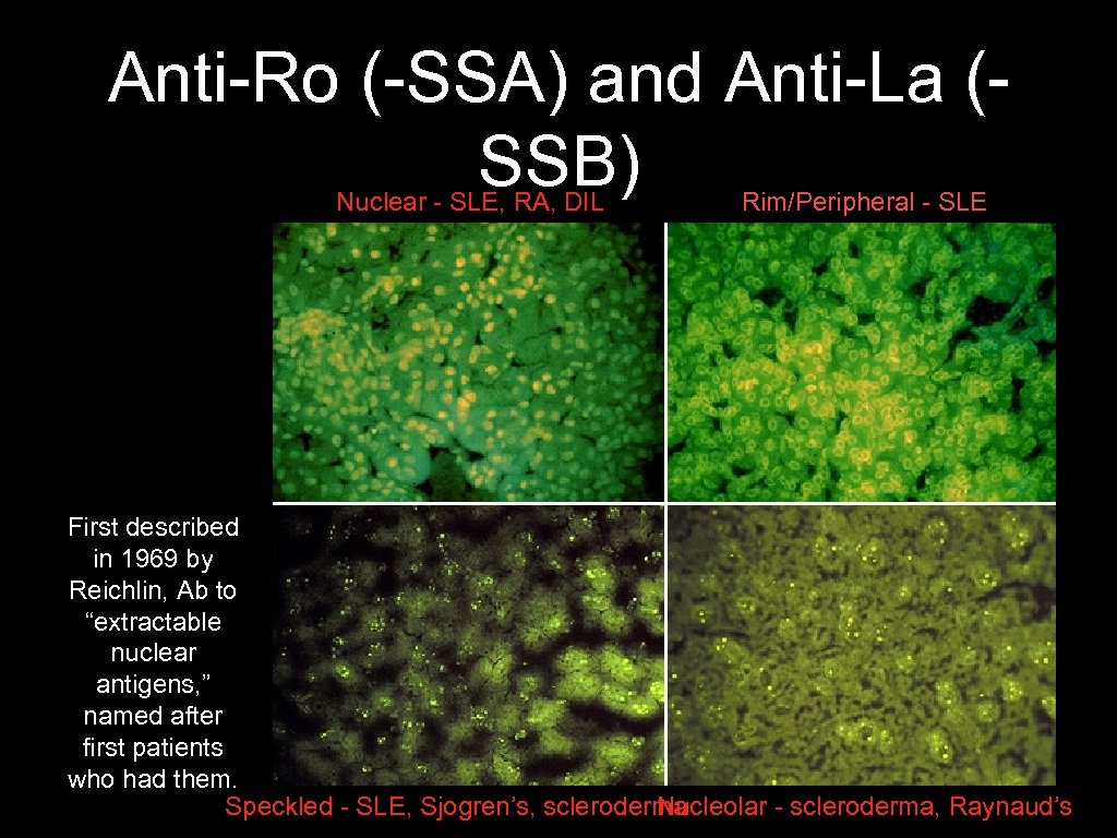 Anti-Ro (-SSA) and Anti-La (SSB) Nuclear - SLE, RA, DIL Rim/Peripheral - SLE First