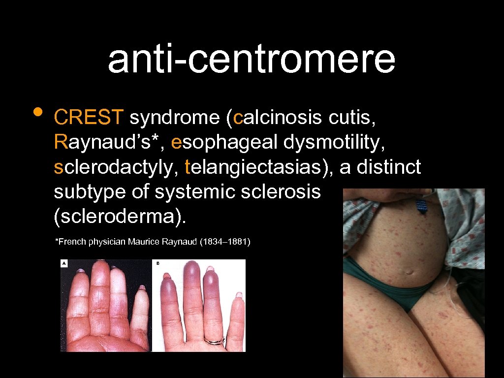 anti-centromere • CREST syndrome (calcinosis cutis, Raynaud’s*, esophageal dysmotility, sclerodactyly, telangiectasias), a distinct subtype